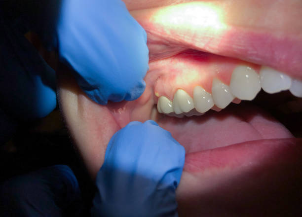 Best Emergency Dentist for Lost Fillings or Crowns in Andrews, IN